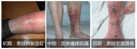 静脉炎的预防及护理方法介绍 昆明三一一医院