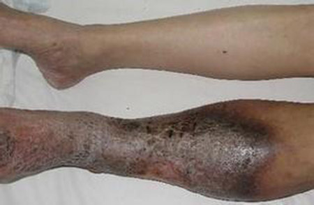 老烂腿为什么会反复发作？