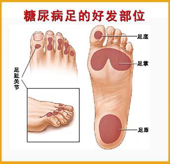 引起糖尿病足的病因