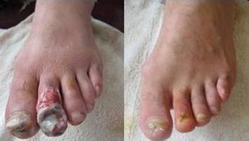 男性如何预防脉管炎?