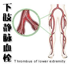 小腿深静脉血栓需要如何保养?