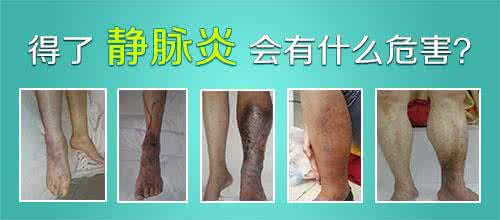 静脉炎的分类与症状表现