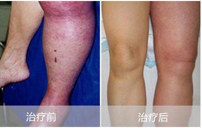 下肢静脉血栓的临床表现有哪些