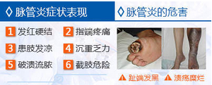 脉管炎不治疗会有哪些危害