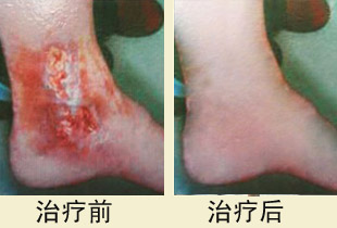 警惕老烂腿癌变,应尽早治疗