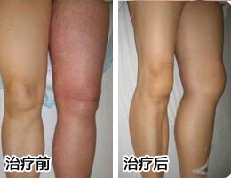 血管堵塞的治疗方法