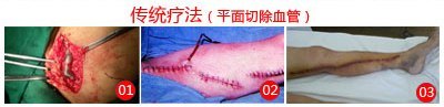 怎样治疗静脉曲张