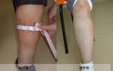 血管堵塞该怎么办