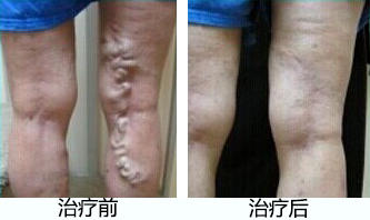 手背血管突出是怎么回事