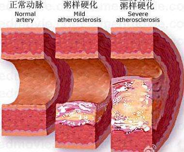动脉硬化症状有哪些