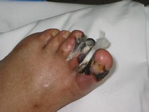 脉管炎早期症状图片