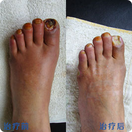 动脉粥样硬化的原因