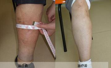下肢静脉血栓治疗费用