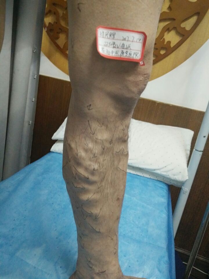 下肢静脉曲张蚯蚓腿