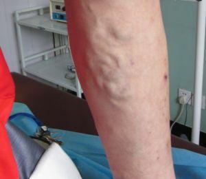 静脉曲张的危害