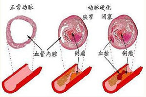 动脉硬化发展恶化