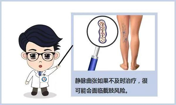 静脉曲张